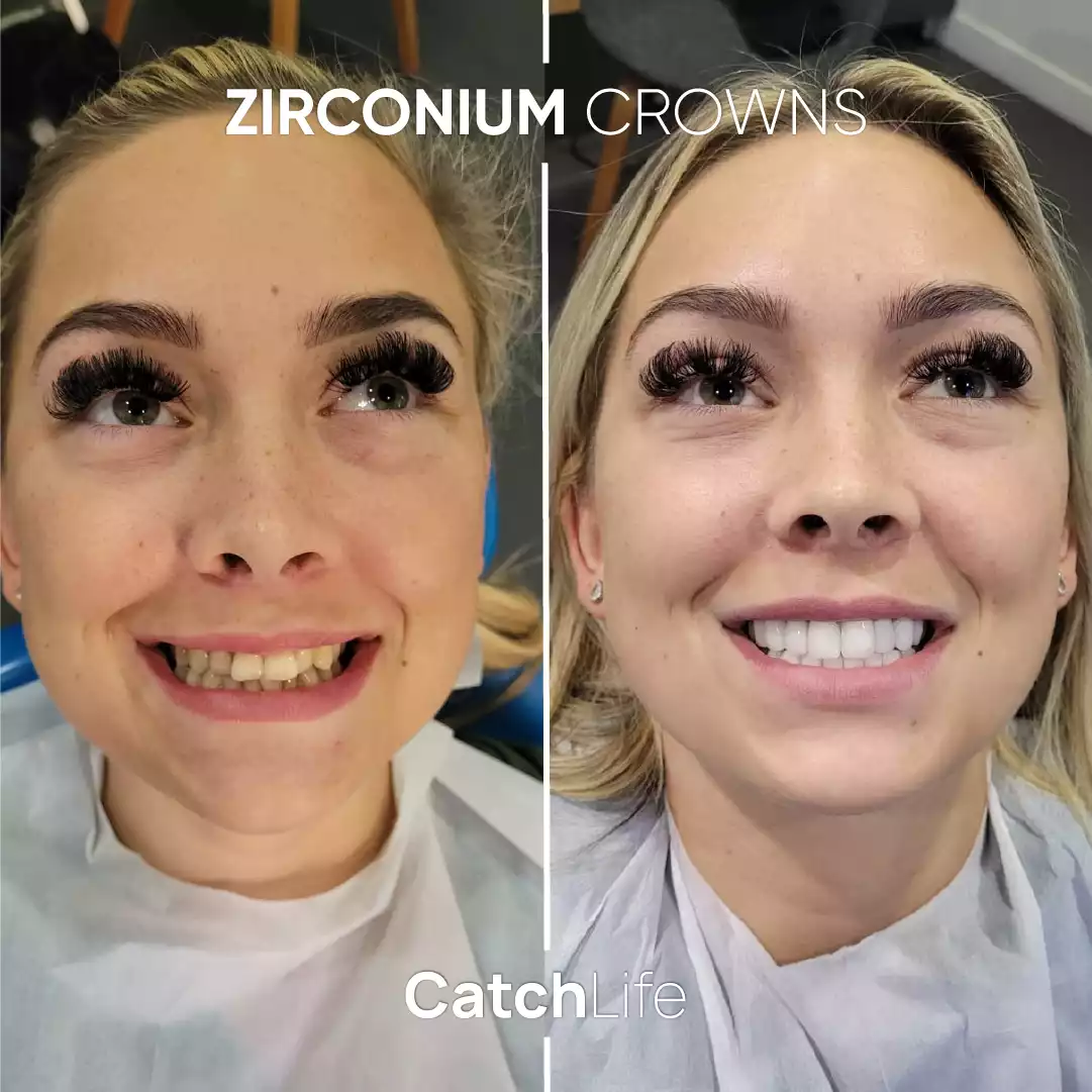 Zirconium Crown Before After