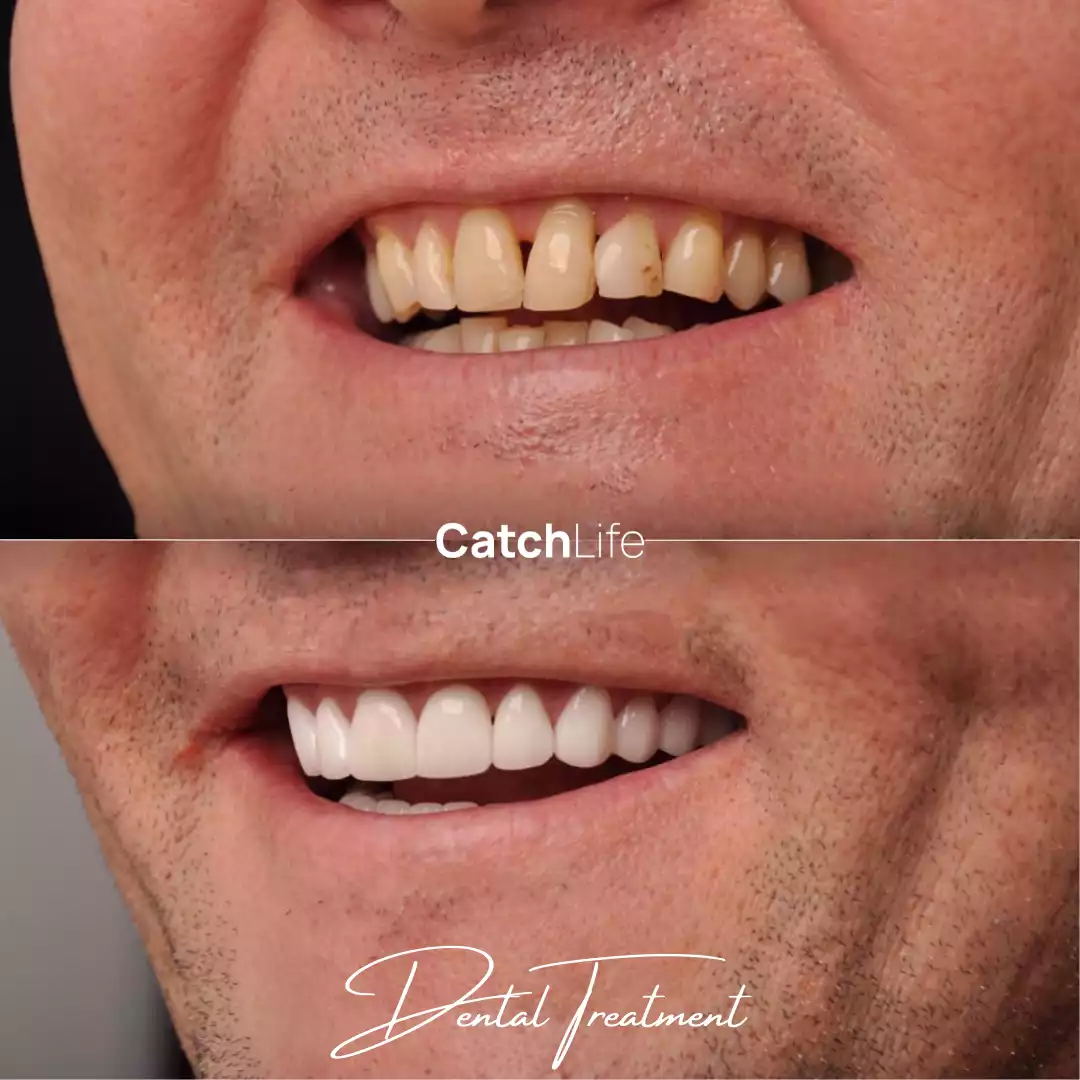 Dental crown before after